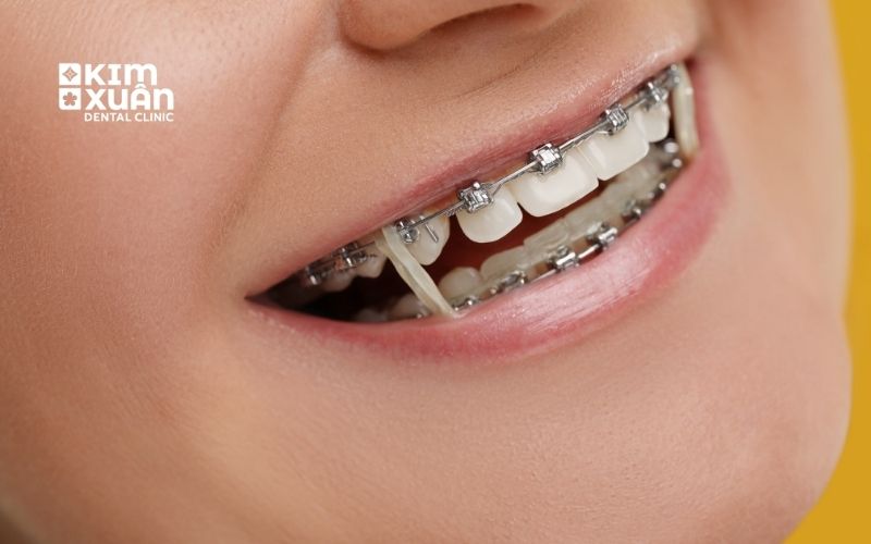 Ưu Nhược Điểm Niềng Răng Mắc Cài Tự Động