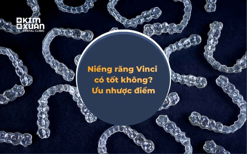 Niềng răng Vinci có tốt không? Ưu nhược điểm