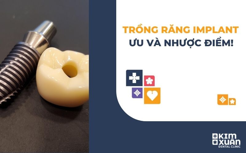 Ưu Nhược Điểm Khi Trồng Răng Implant