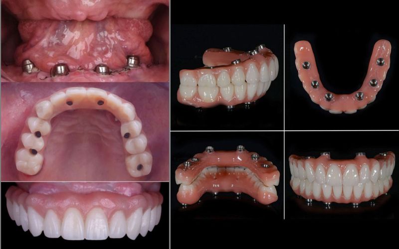 Ưu Nhược Điểm Trồng Răng Implant