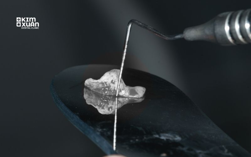 Vật Liệu Ghép Xương Trong Implant