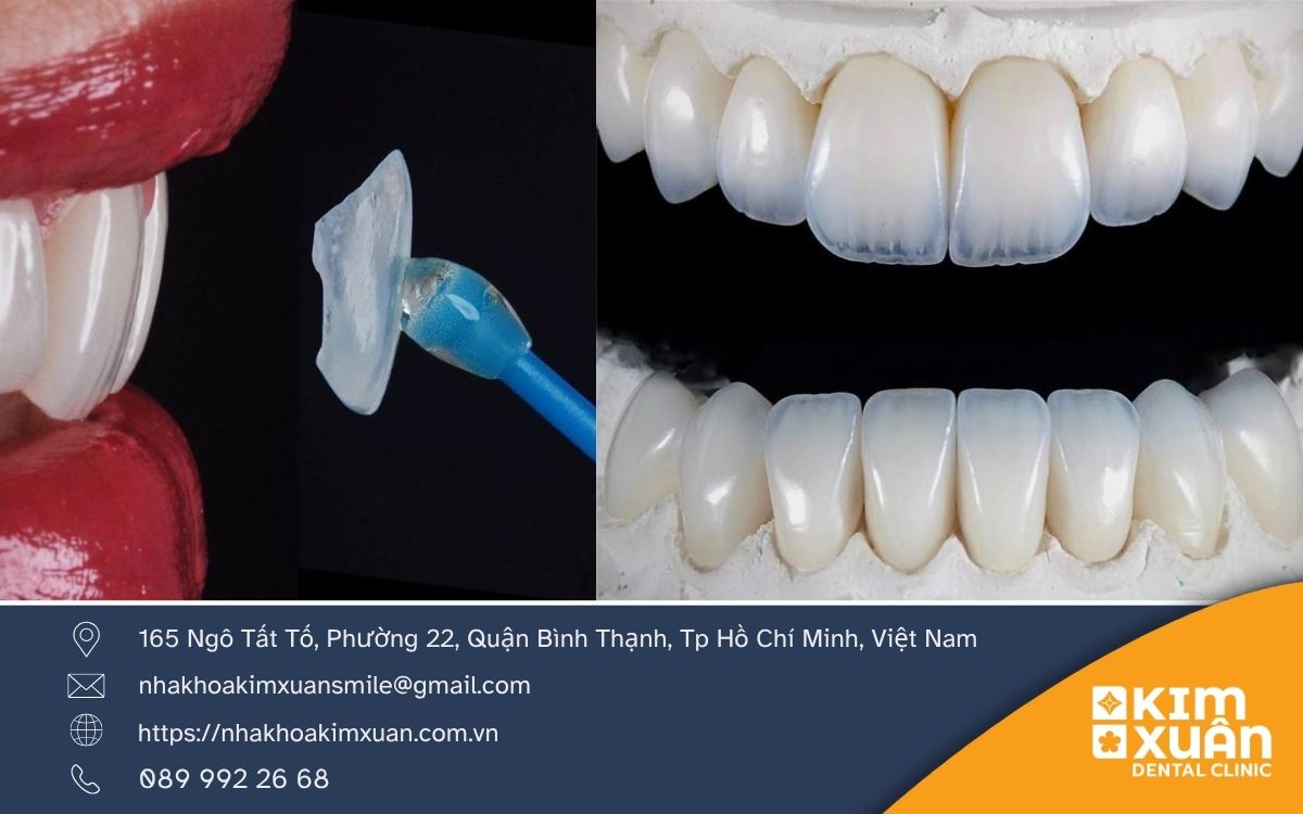 Veneer Emax Là Gì?