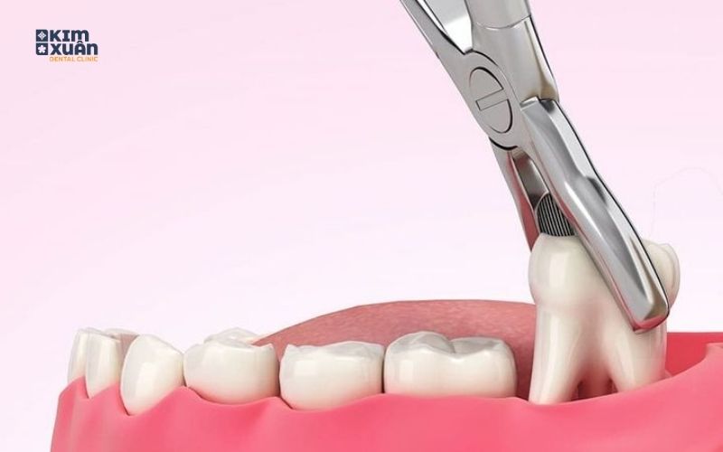 Vì Sao Cần Kiêng Ăn Một Số Thực Phẩm Sau Khi Nhổ Răng