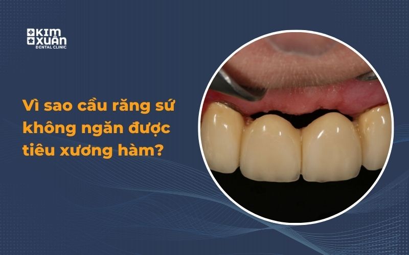 Vì Sao Cầu Răng Sứ Không Ngăn Được Tiêu Xương Hàm
