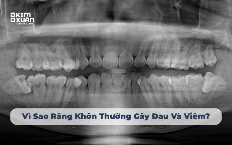 Vì sao mọc răng khôn thương hay gây đau và viêm