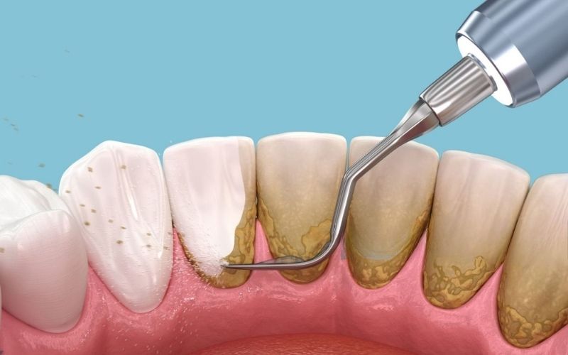 Vì Sao Nên Cạo Vôi Răng Định Kỳ