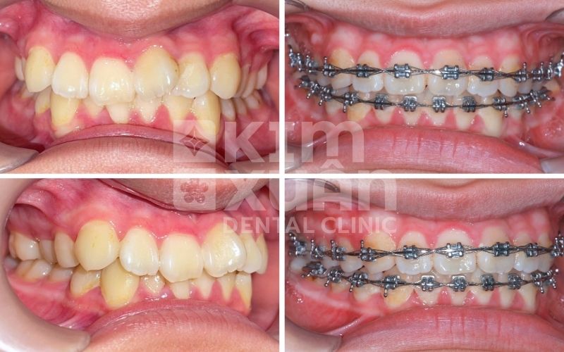 Vì Sao Nên Niềng Răng Sớm Cho Trẻ Em?