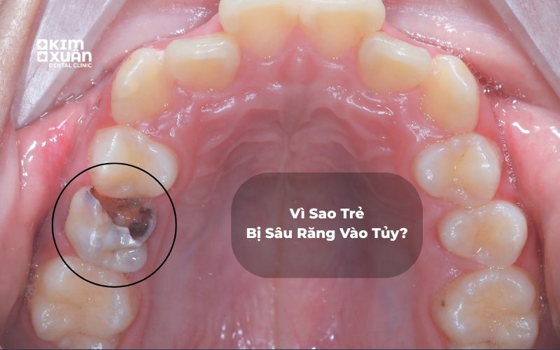 Nguyên Nhân Trẻ Bị Sâu Răng Vào Tủy
