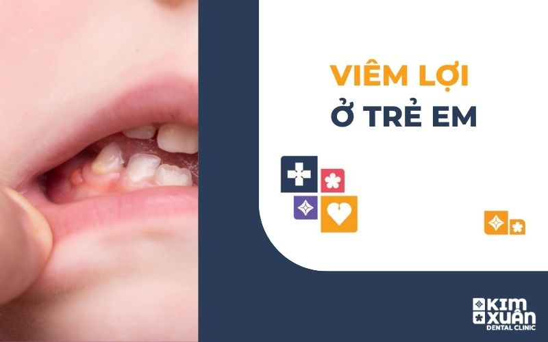 Viêm Lợi Ở Trẻ Em