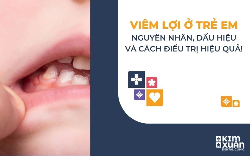 Viêm Lợi Ở Trẻ Em