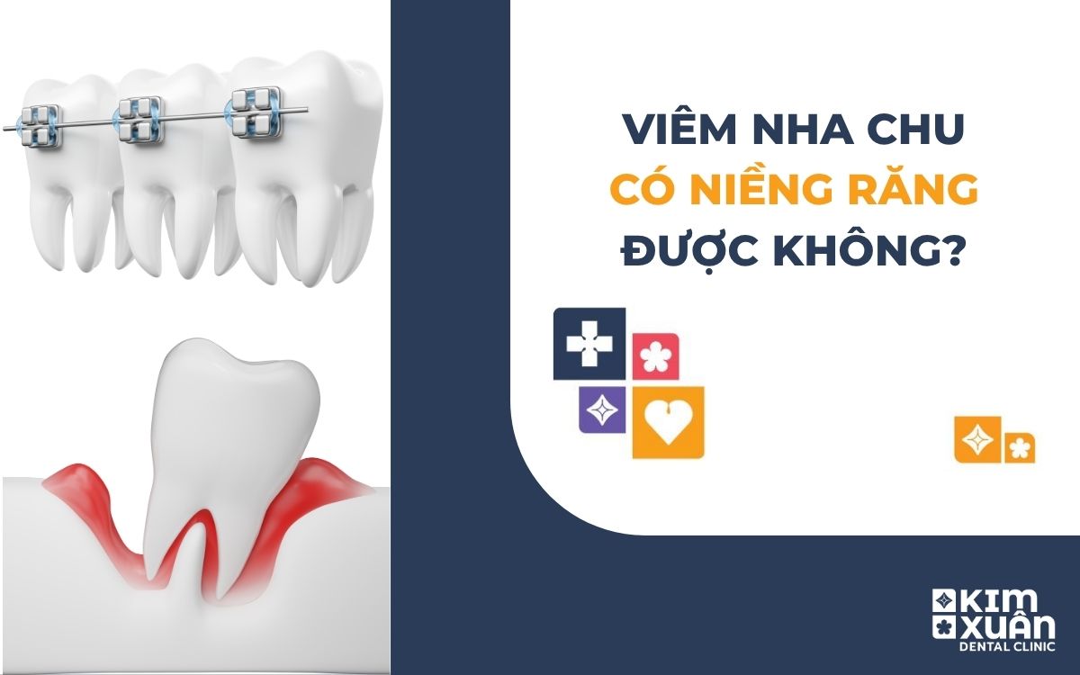 Viêm Nha Chu Có Niềng Răng Được Không?