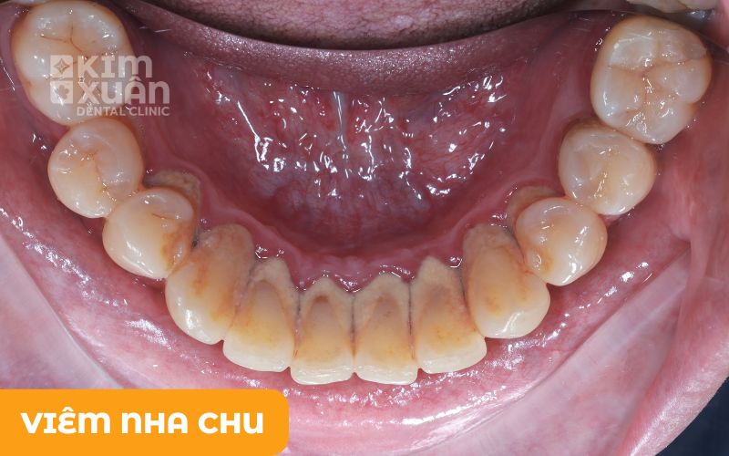 Viêm Nha Chu Gây Ra Răng Lung Lay
