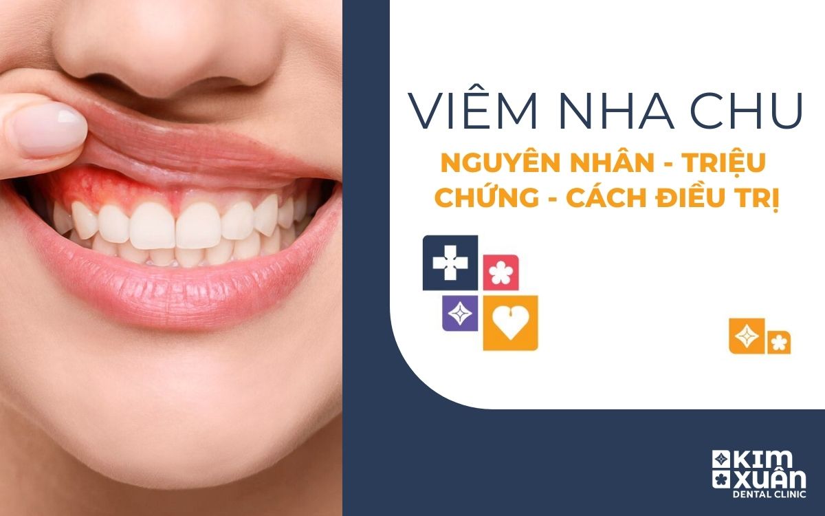 Viêm Nha Chu - Cách Điều Trị Viêm Nha Chu