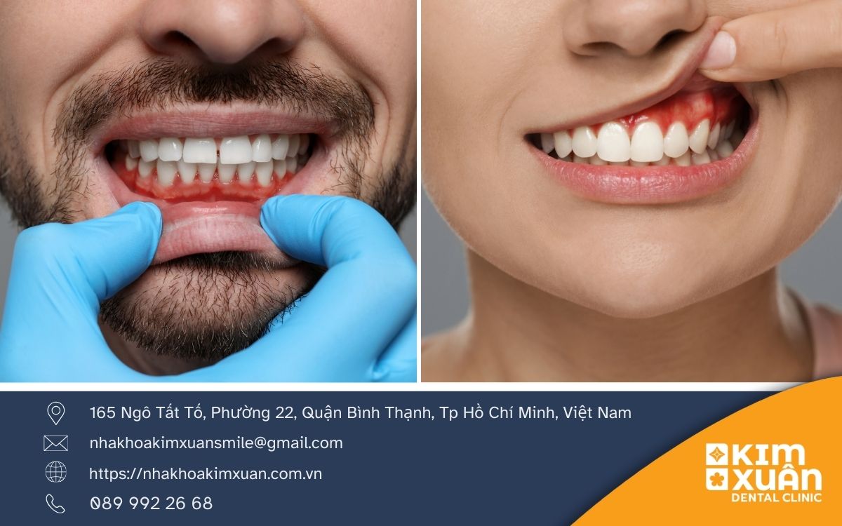 Viêm Nướu Là Gì?