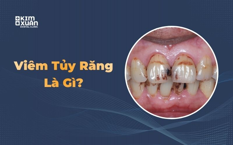 Viêm tủy răng