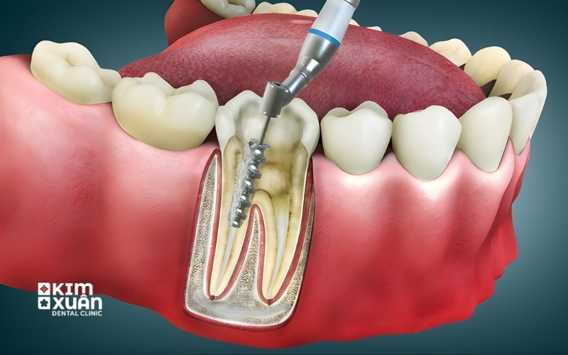 Viêm Tủy Răng Có Nguy Hiểm Không