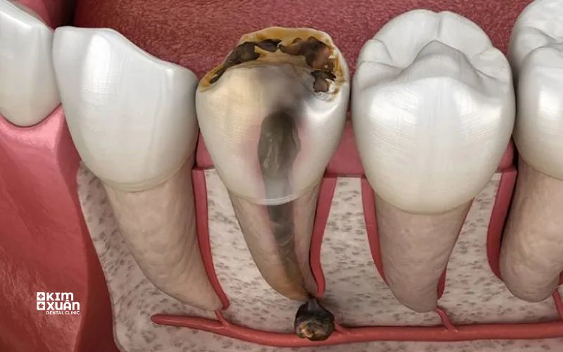 Viêm Tủy Răng Có Tự Khỏi Không