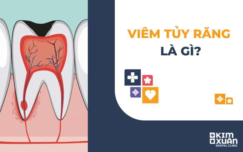 Viêm Tủy Răng