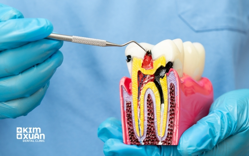 Viêm Tủy Răng Là Gì