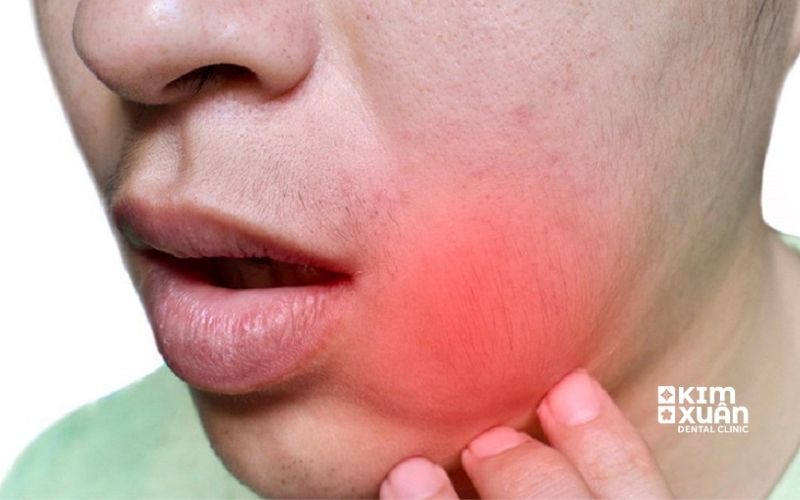 Viêm Tủy Răng Má Sưng To Đỏ